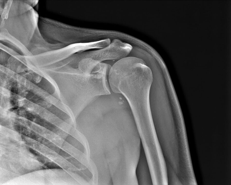 Radiografía de artrosis de la articulación del hombro de segundo grado de gravedad. 