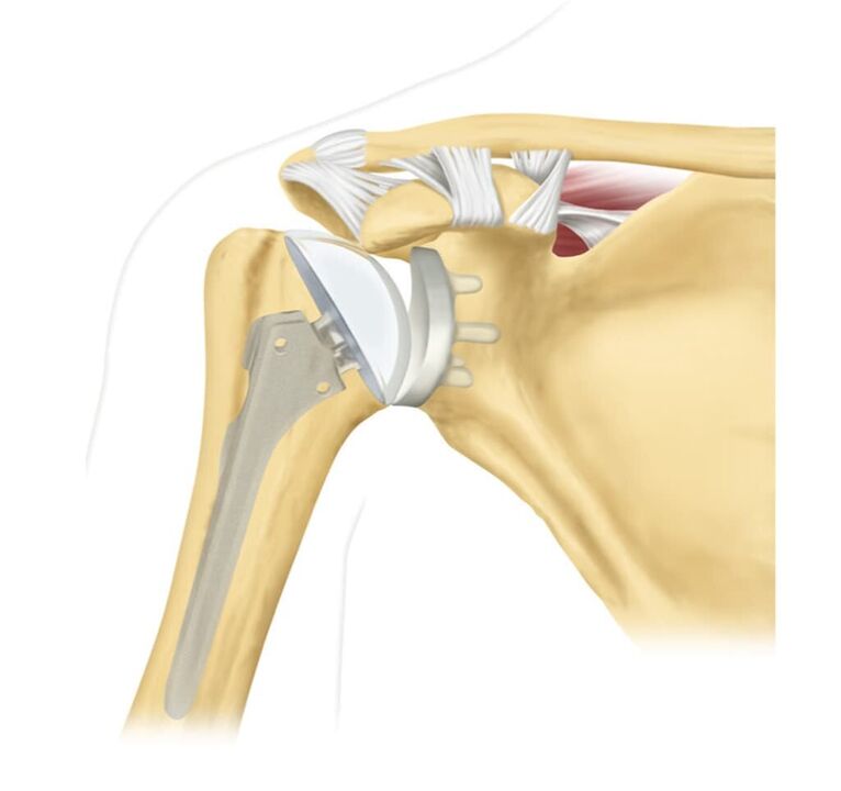 Reemplazo de una articulación del hombro dañada con una endoprótesis
