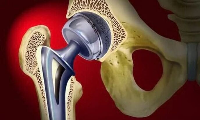Reemplazo de articulación de cadera para artrosis