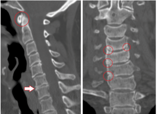 La tomografía computarizada muestra vértebras y discos dañados de altura heterogénea debido a la osteocondrosis torácica. 