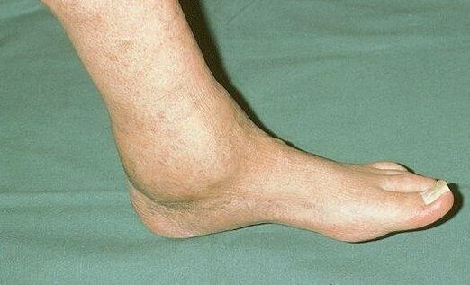 hinchazón del tobillo con artrosis