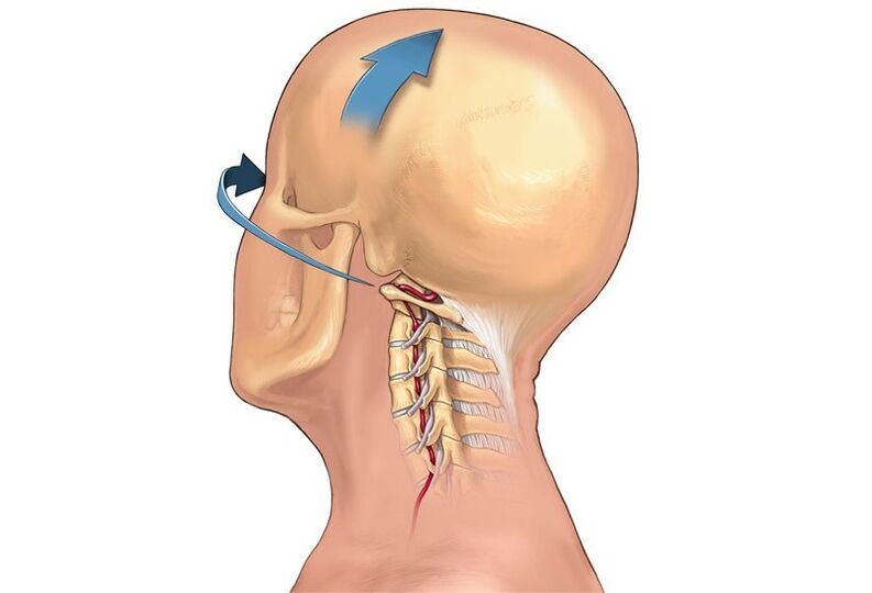 crujido de cuello al girar la cabeza como síntoma de osteocondrosis cervical