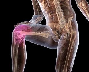 Inflamación de la articulación de la rodilla con artrosis. 