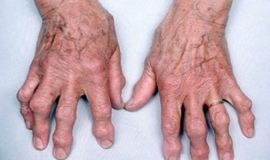 cómo distinguir la artritis de los dedos de la artrosis