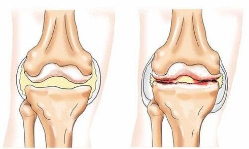 articulación de rodilla sana y afectada por artrosis