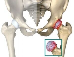 Causas de atrosis de la articulación de la cadera.