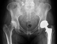 diagnóstico de artrosis de la articulación de la cadera