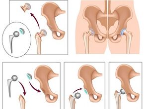 endoprótesis para la artrosis de la articulación de la cadera