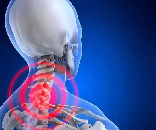 Osteocondrosis cervical