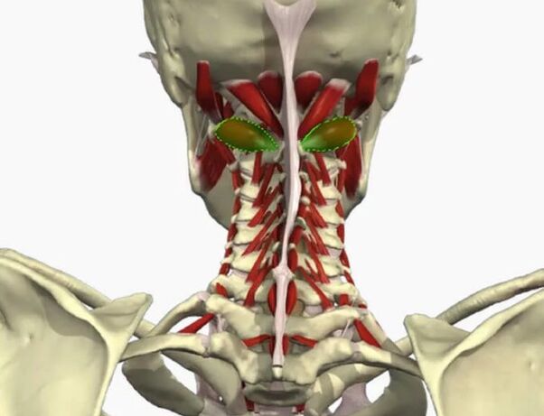 Síndrome de la arteria vertebral