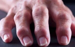artritis reumatoide como causa de dolor articular